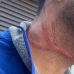 Motociclista cai e tem pescoço ferido por fio de internet solto em Ituiutaba